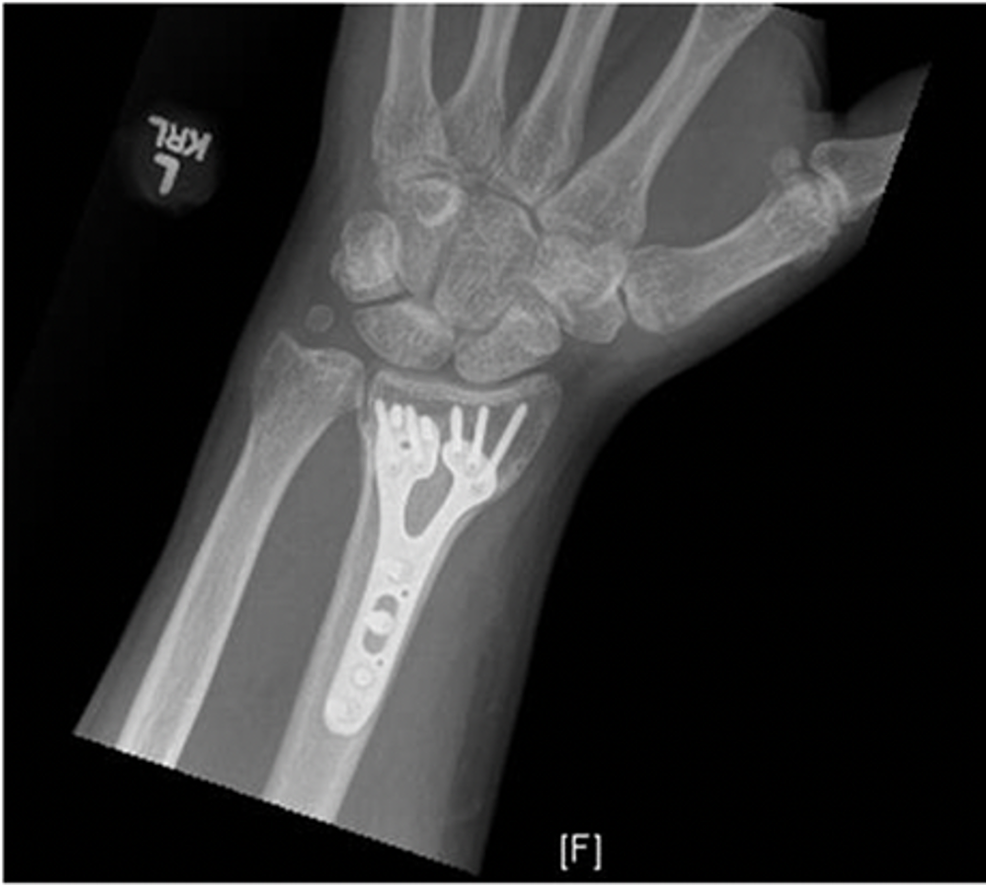 Cureus Intraoperative Anaphylaxis in Response to Hemostatic Agents