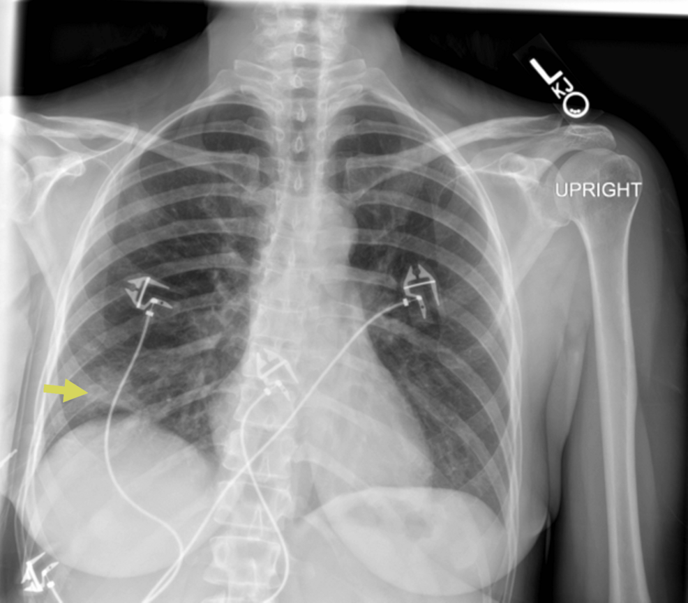 Chest-radiograph-showing-right-basilar-opacities-(yellow-arrow) Chest-radiograph-showing-right-basilar-opacities-(yellow-arrow)
