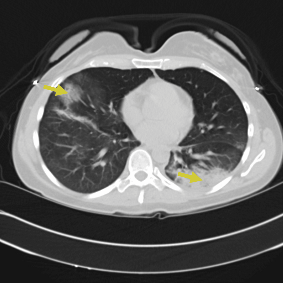 CT-chest-obtained-on-presentation-showing-bilateral-ground-glass-opacities-and-consolidations-(yellow-arrows) CT-chest-obtained-on-presentation-showing-bilateral-ground-glass-opacities-and-consolidations-(yellow-arrows)