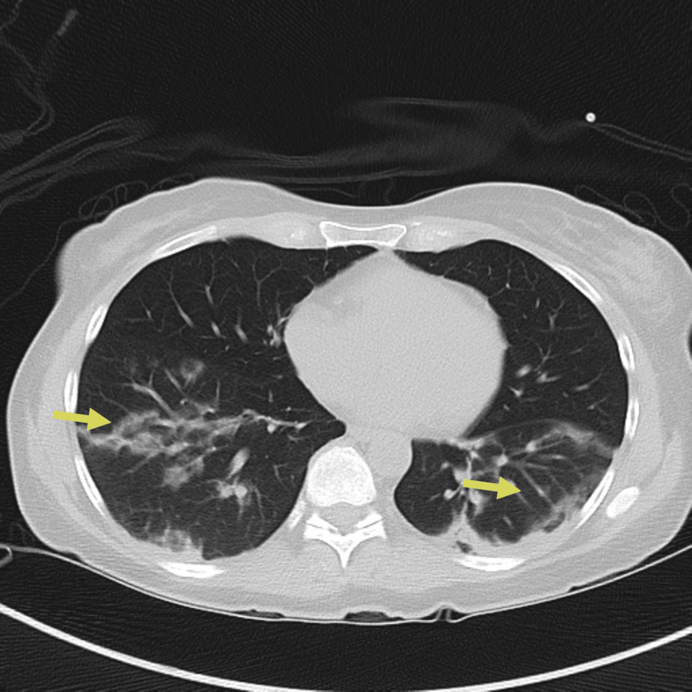 Repeat-CT-chest-on-day-three-of-hospitalization-showing-worsening-mixed-consolidative-and-ground-glass-opacities,-particularly-on-the-left-lung-(yellow-arrows) Repeat-CT-chest-on-day-three-of-hospitalization-showing-worsening-mixed-consolidative-and-ground-glass-opacities,-particularly-on-the-left-lung-(yellow-arrows)
