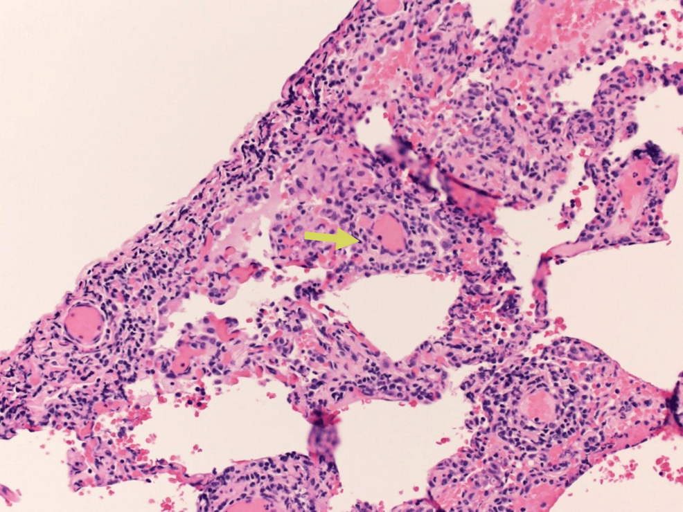 Photomicrograph-showing-Masson-bodies-or-intraluminal-collagen-plugs-(yellow-arrow) Photomicrograph-showing-Masson-bodies-or-intraluminal-collagen-plugs-(yellow-arrow)