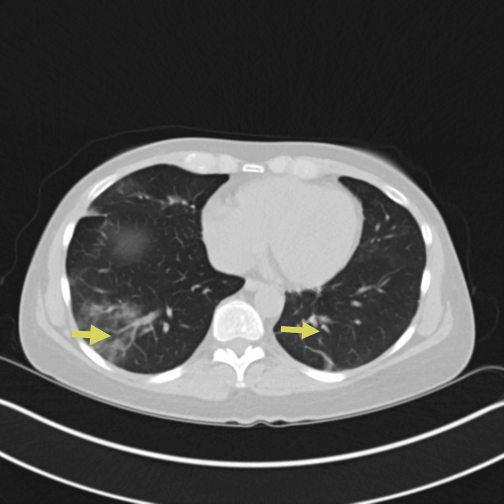 CT-chest-showing-persistent-bilateral-pulmonary-opacities/ground-glass-opacities-(yellow-arrows) CT-chest-showing-persistent-bilateral-pulmonary-opacities/ground-glass-opacities-(yellow-arrows)