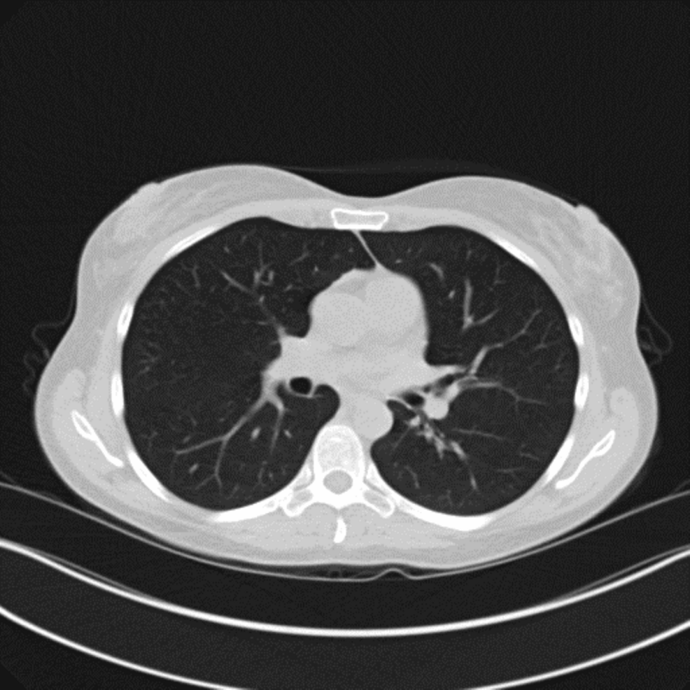 CT-chest-showing-interval-resolution-of-previously-seen-ground-glass-opacities- CT-chest-showing-interval-resolution-of-previously-seen-ground-glass-opacities-