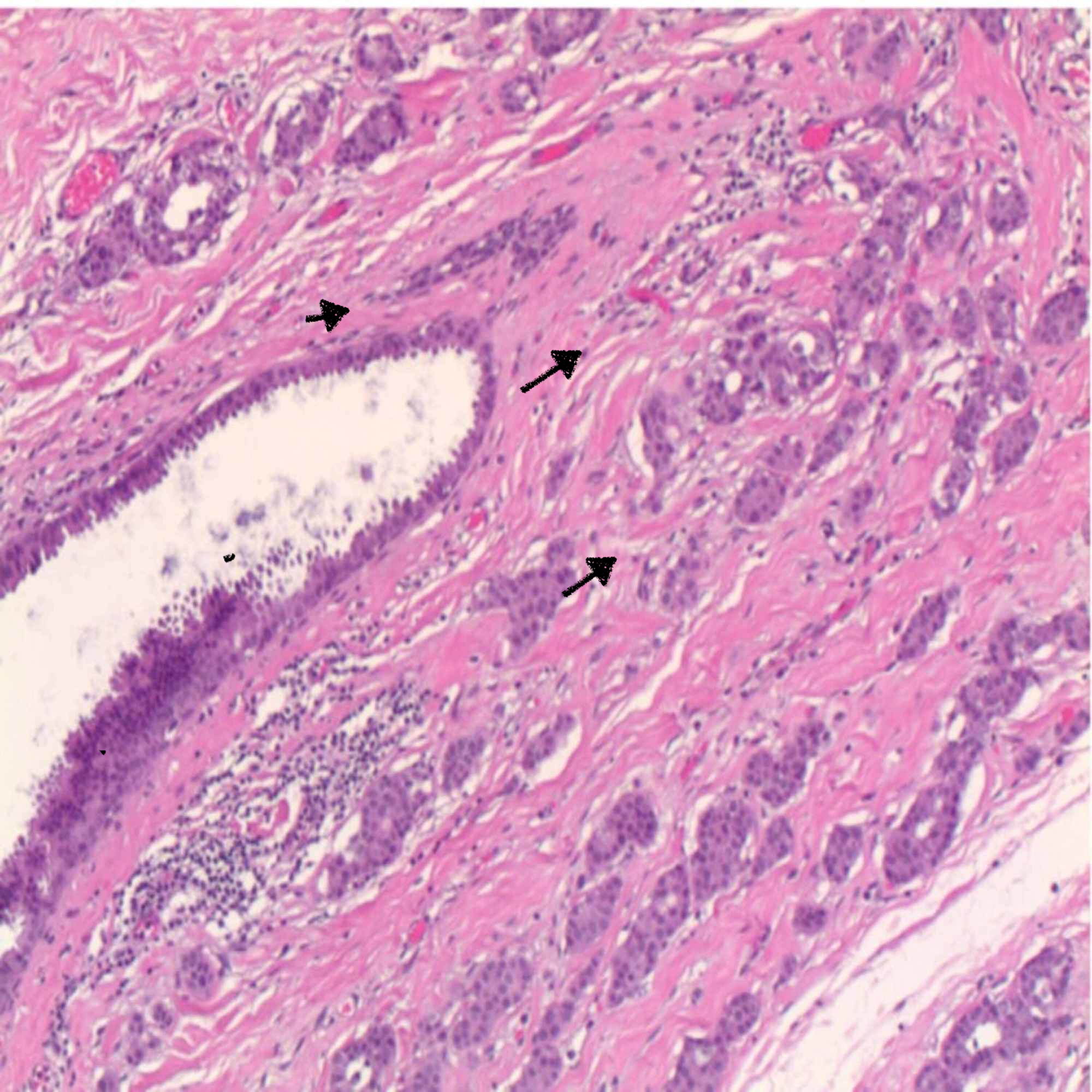 Cureus A Rare Presentation Of An Invasive Ductal Carcinoma Of Ectopic