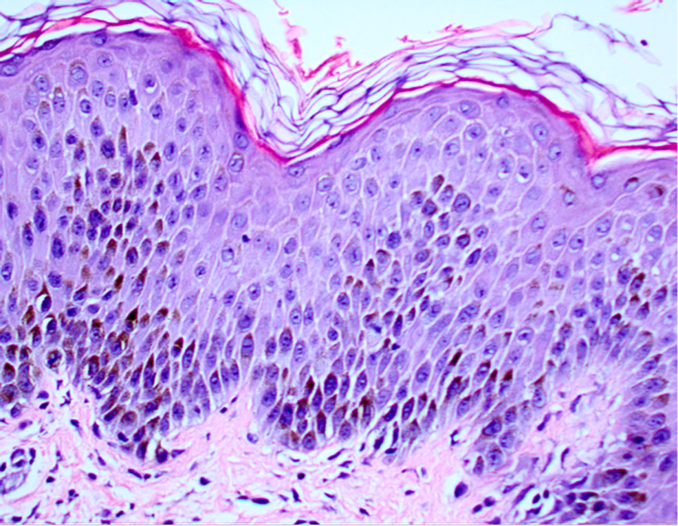 Histology-of-an-unaffected-segment-of-skin-taken-from-a-55-year-old-African-American-male-presenting-with-acute-generalized-exanthematous-pustulosis.-