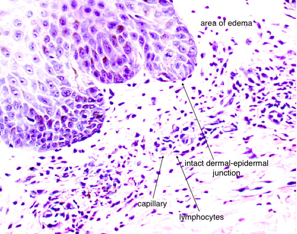 Dermal-perivascular-lymphocytic-infiltration-with-edema.-