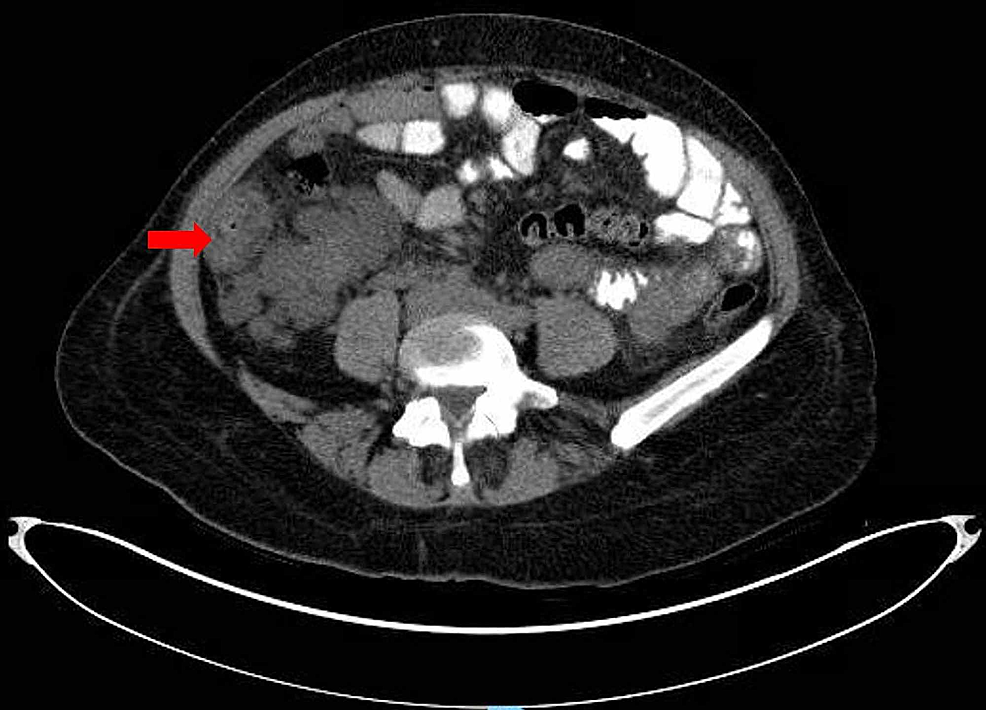 Thickening Of Ascending Colon