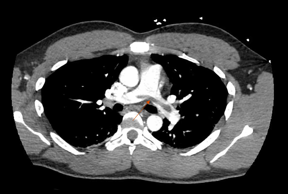 Percutaneous Mechanical Pulmonary Thrombectomy in a Patient With