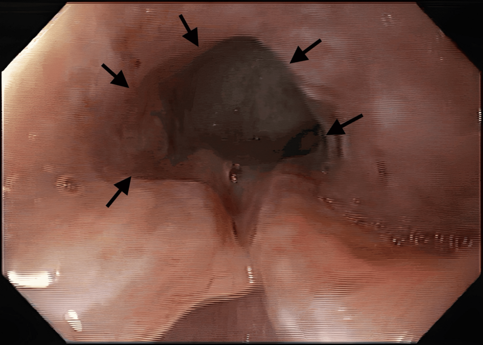 Upper-endoscopy-showing-an-ulcerated-tumor-occupying-approximately-two-thirds-of-the-esophageal-lumen-(arrows)