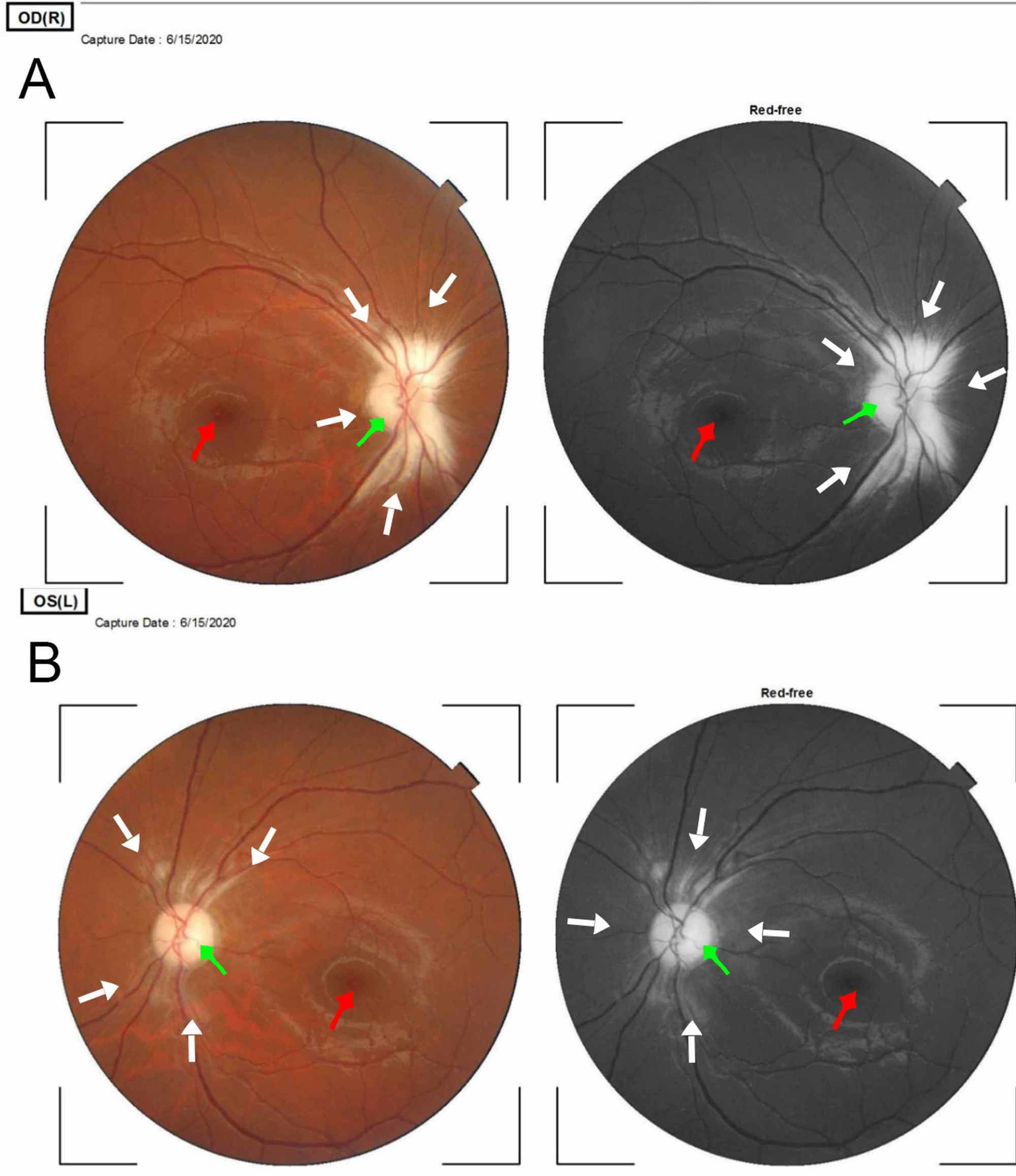 Cureus Bilateral Peripapillary Retinal Nerve Fiber Layer Myelination