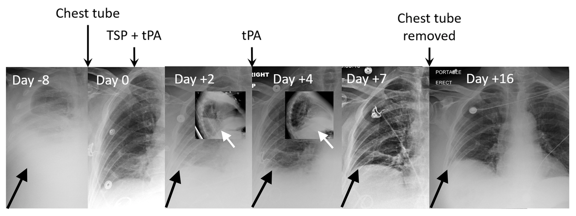 Cureus | Intrapleural Fibrinolytic Therapy Improves Results With Talc ...