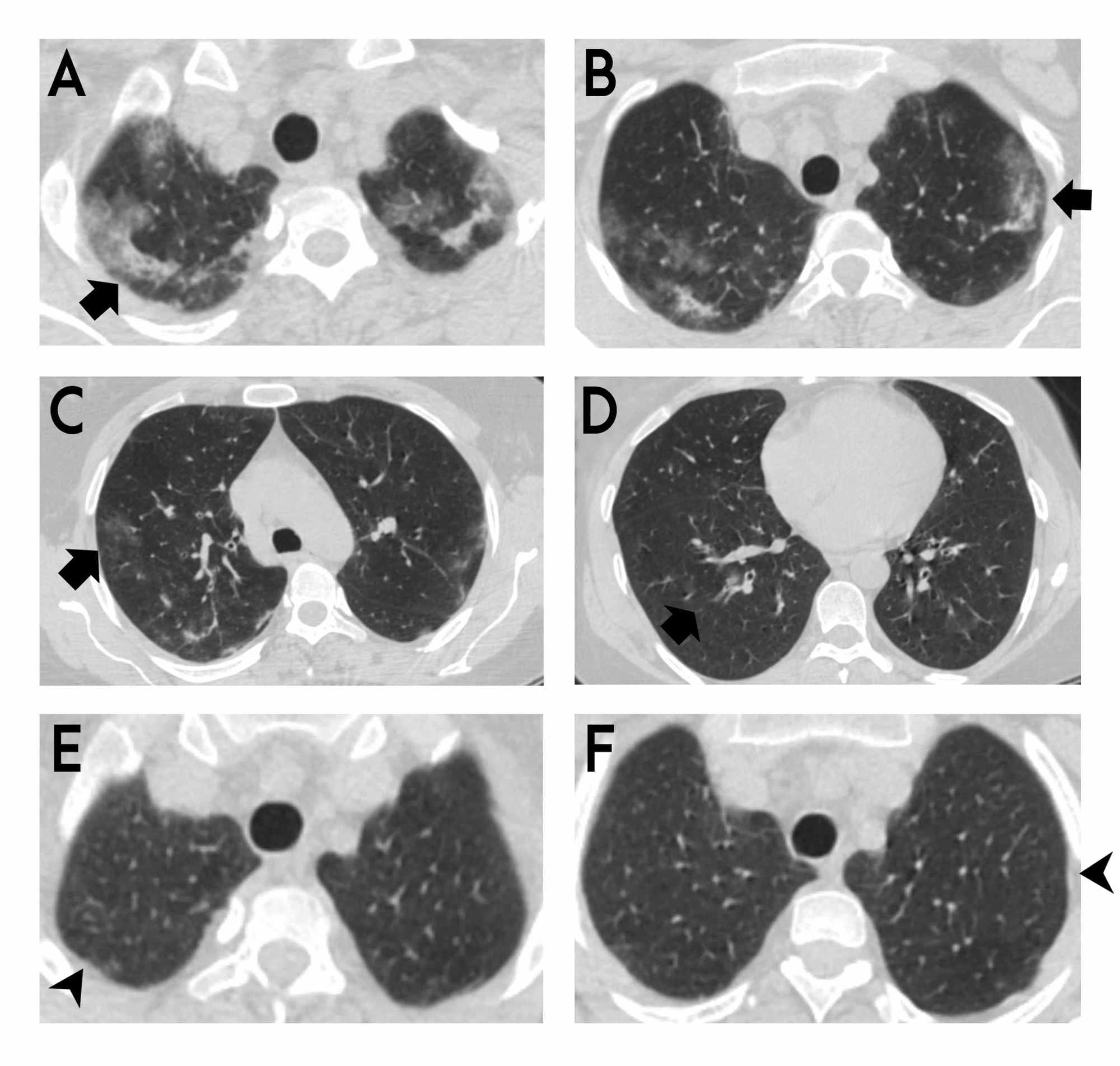 Cureus | Non-Infectious Diseases Compatible With COVID-19 Pneumonia