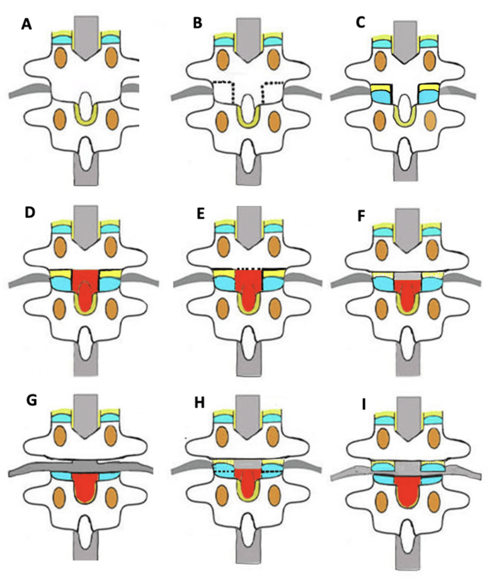 The Technique of a Modified Ponte Osteotomy Using Ultrasonic Bone Scalpel  in Spinal Deformity Correction: Does It Save Time and Reduce Blood Loss? |  Cureus