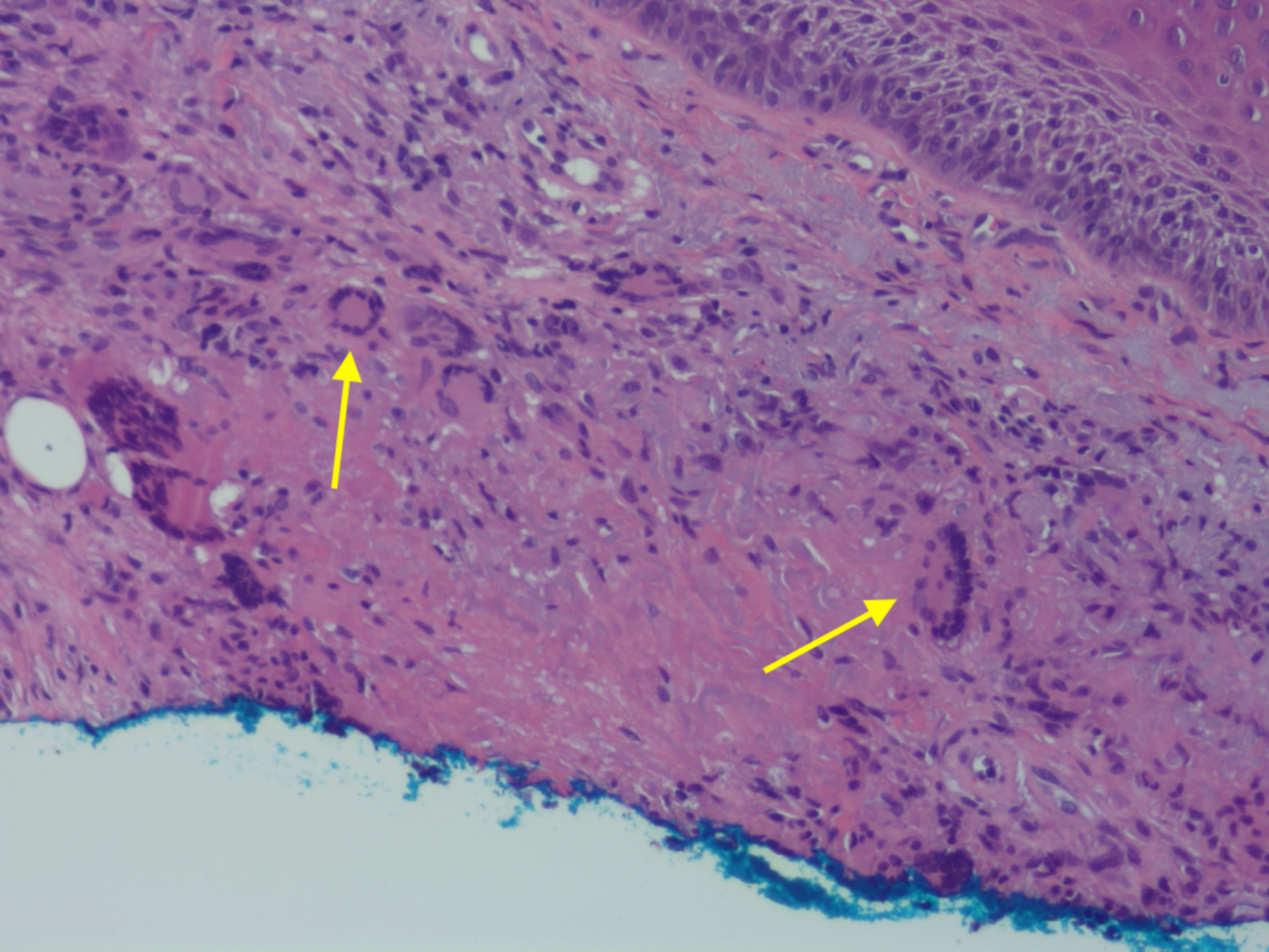 Cureus | Perforating Granuloma Annulare Mimicking Psoriasis