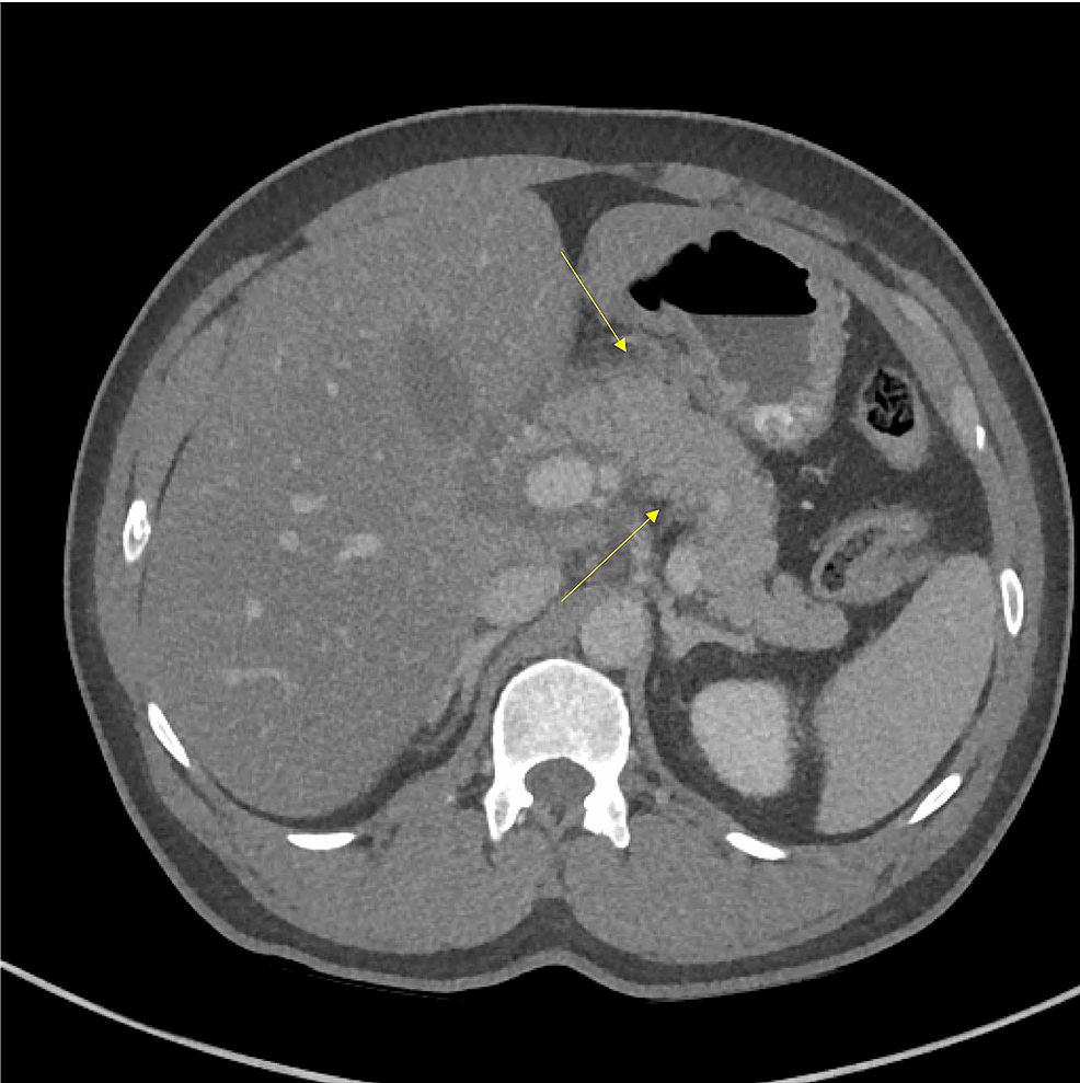 Abdominal-CT-scan-with-contrast