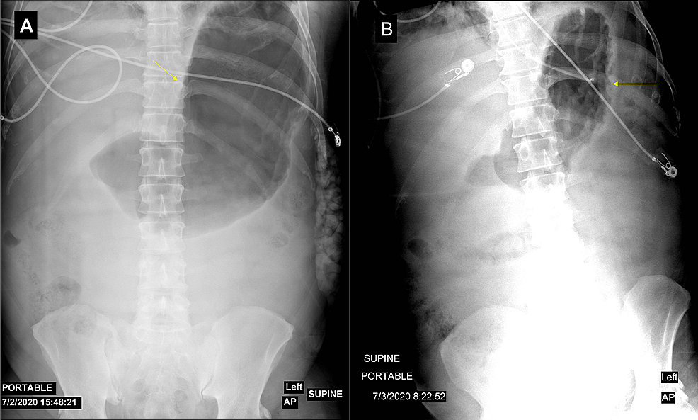 Kidney,-ureter,-and-bladder-(KUB)-X-ray