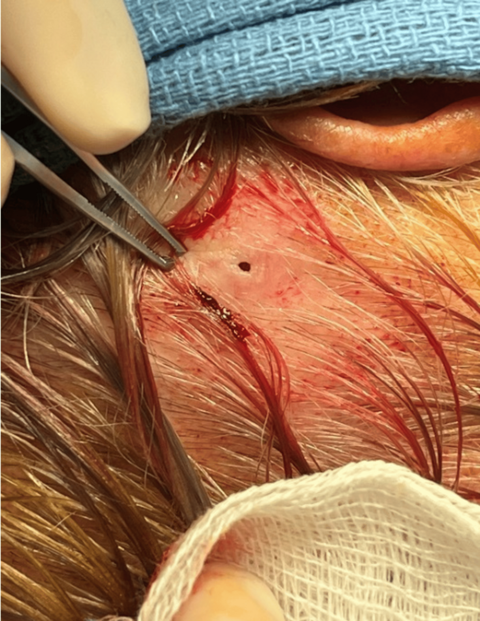 When Artificial Intelligence (AI) Met a Botfly: The First AI-Assisted Diagnosis of Cutaneous Furuncular Myiasis in a Community-Based Surgical Practice