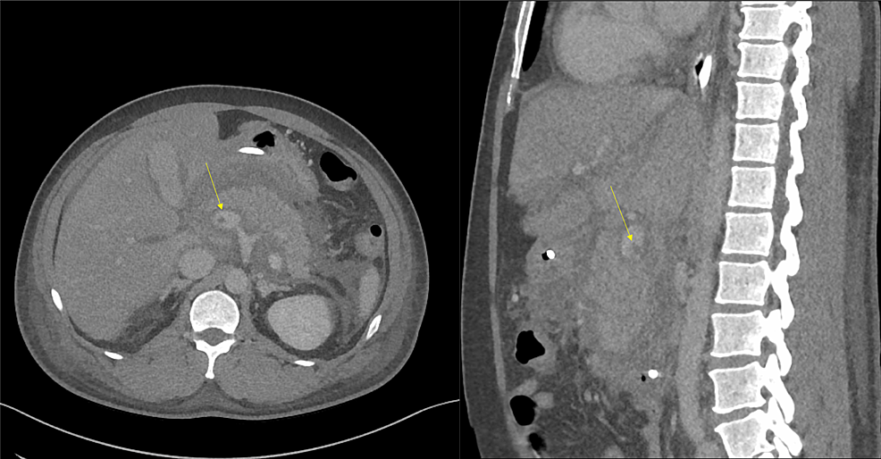 Repeat-abdominal-CT-scan-with-contrast