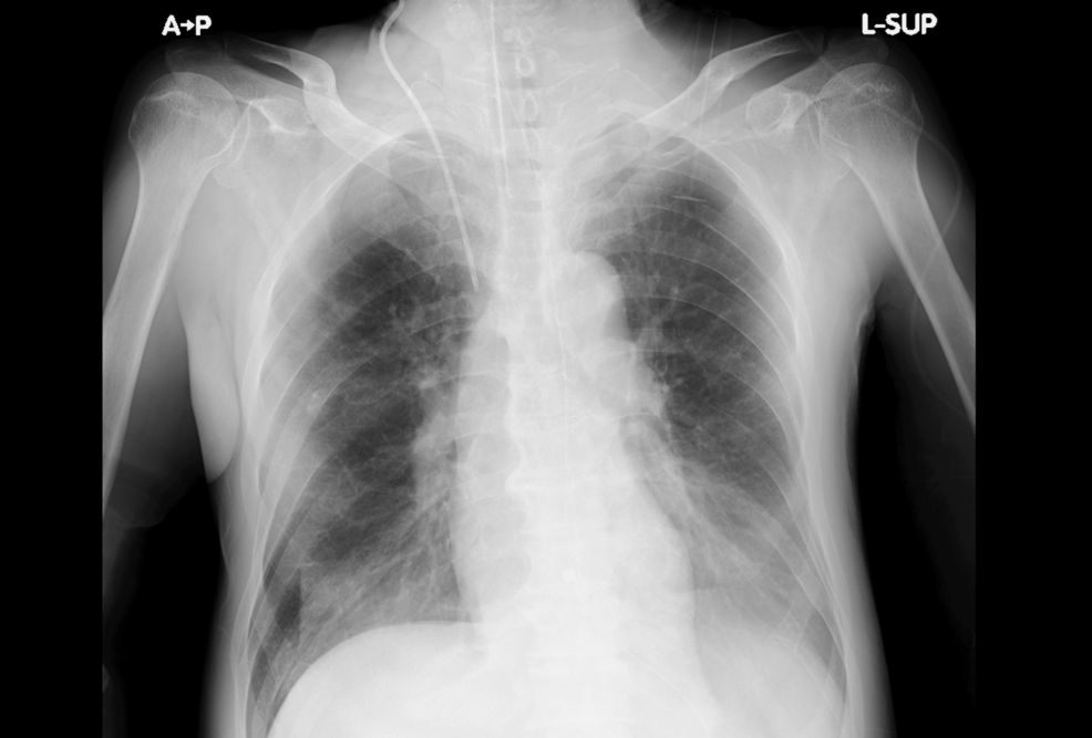 Chest-X-ray-on-day-25 Chest-X-ray-on-day-25