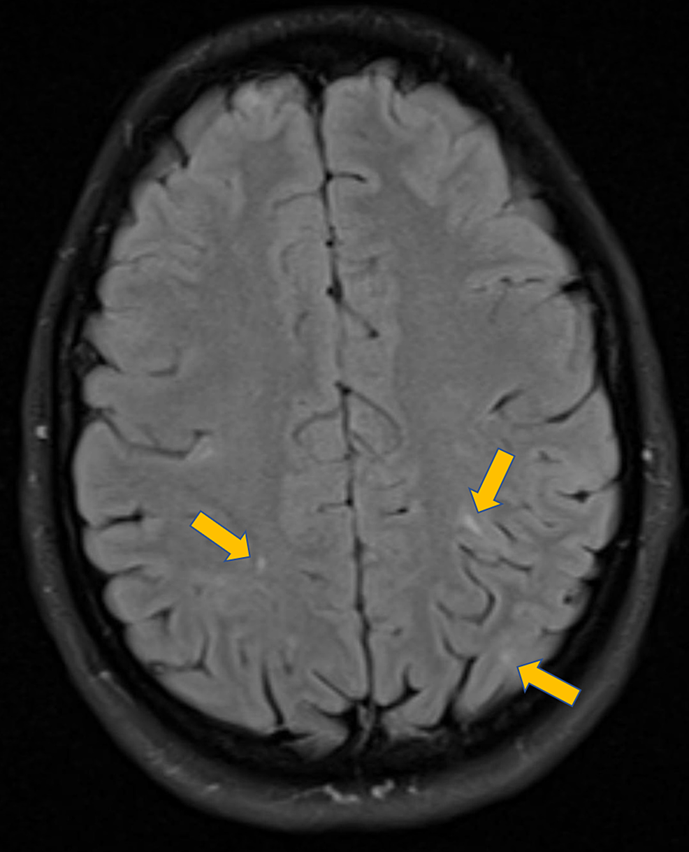 Cureus Cutaneous Lesions as the Sole Presentation of Tuberous Sclerosis