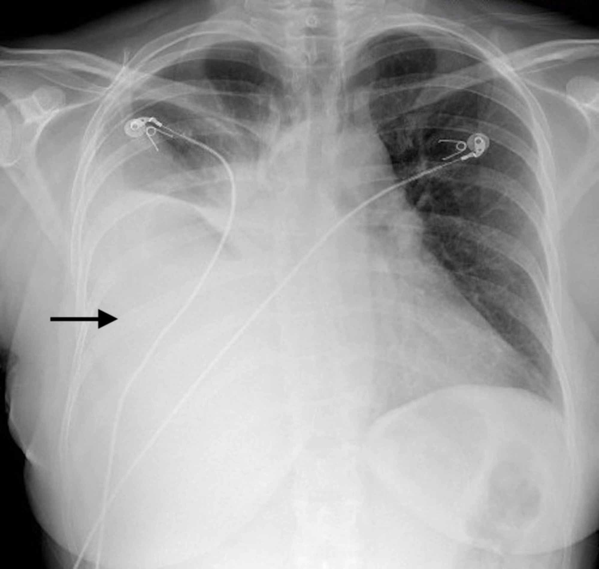 Cureus | Choriocarcinoma Presenting as a Pleural Effusion