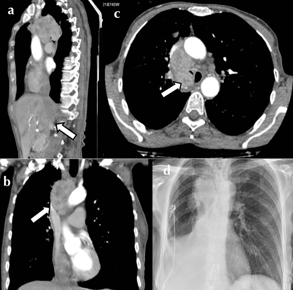 Computed-tomography-(CT)-and-chest-X-ray-(CXR)-imaging-demonstrating-a-large-mixed-density-mediastinal-mass-causing-right-main-bronchus-compression-and-right-middle-and-lower-lobe-collapse:-(a)-sagittal,-(b)-coronal,-(c)-axial,-and-(d)-AP-CXR.