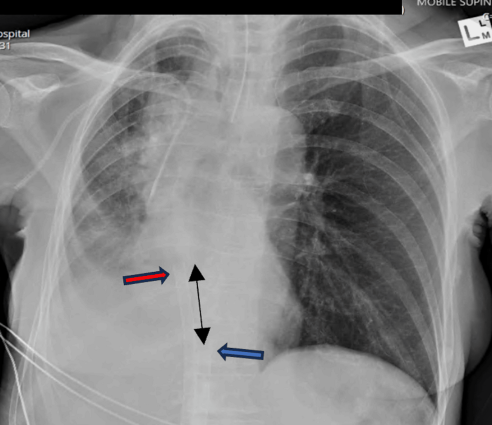 CXR-post-VVECMO-cannulation.