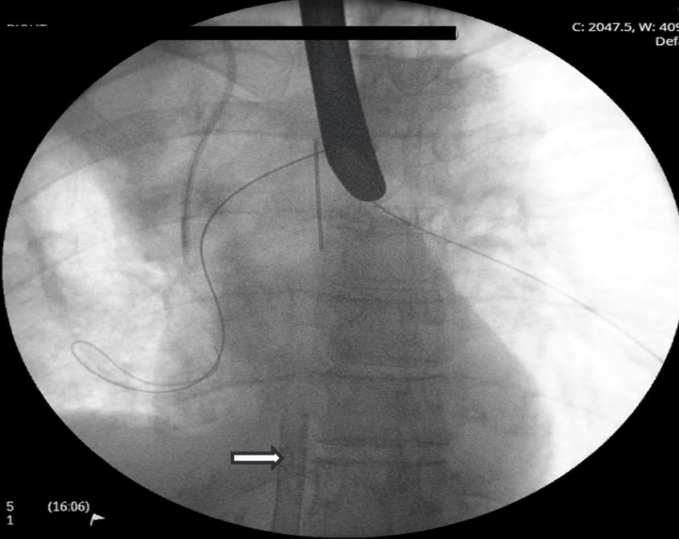 Fluoroscopy:-Rigid-bronchoscopy-deployment-of-bifurcation-wires-to-guide-tracheal-Y-stent-during-apnoeic-period.