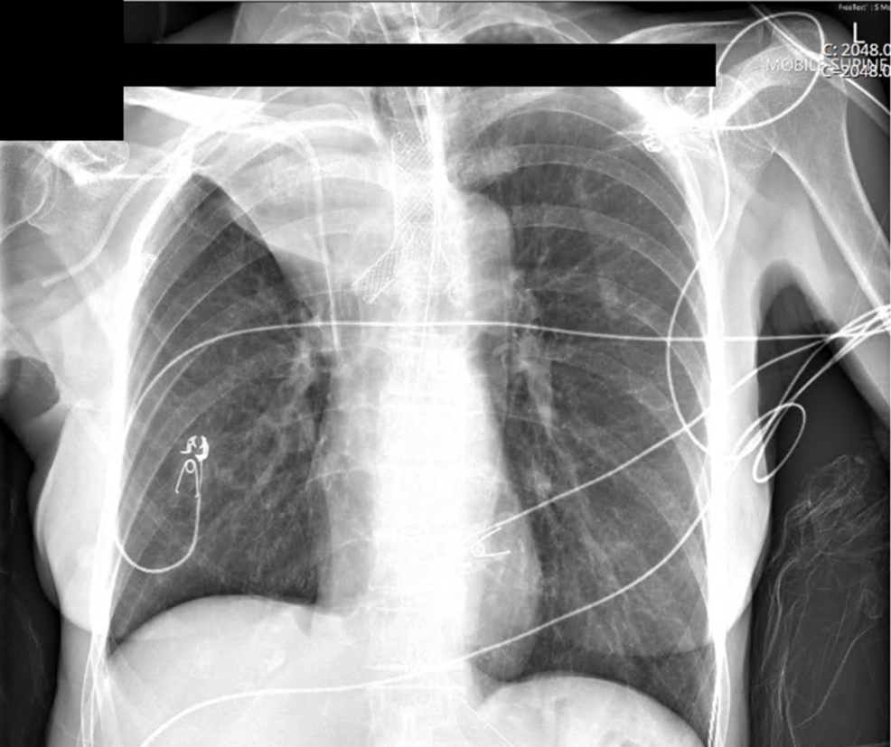 Postoperative-AP-CXR-demonstrating-reversed-nitinol-coated-Y-stent-(note:-position-with-long-left-main-bronchus-projection-intentionally-deployed-to-the-RMB)-with-sacrifice-of-the-right-upper-lobe-(RUL),-but-restoration-of-right-middle-lobe-(RML)-and-right-lower-lobe-(RLL)-aeration.