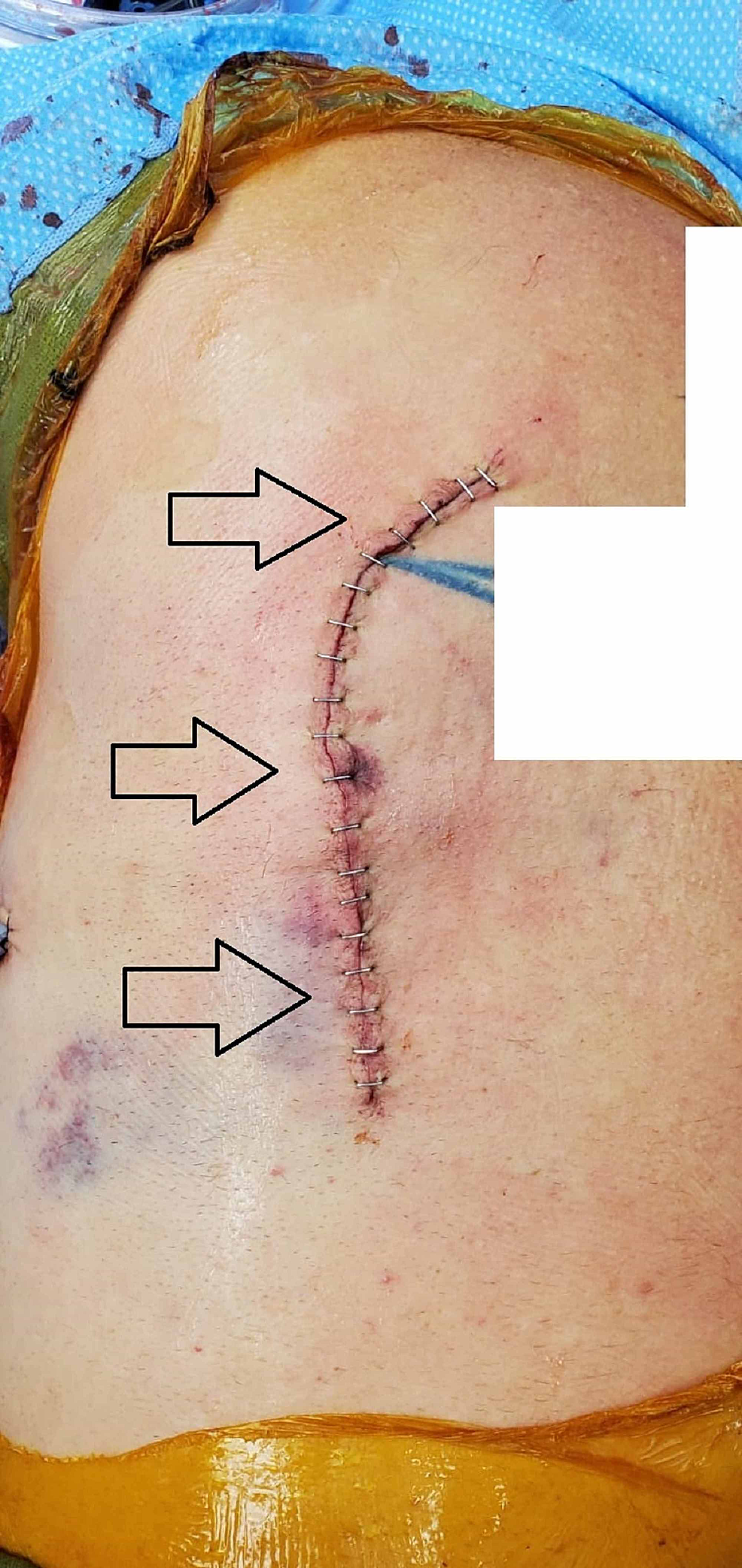 Cureus Negative Pressure Wound Therapy Can Prevent Surgical Site