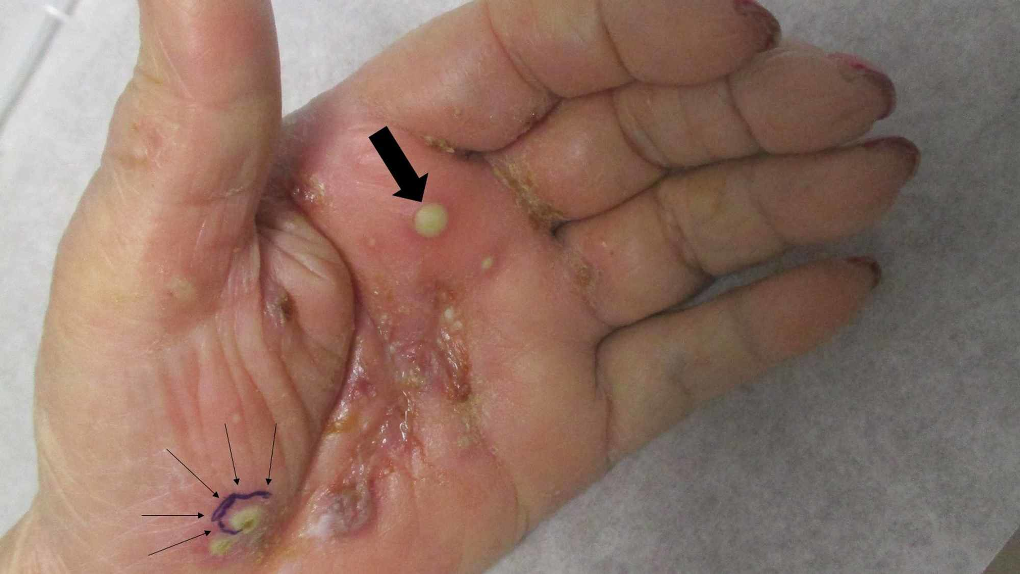 Scabies How To