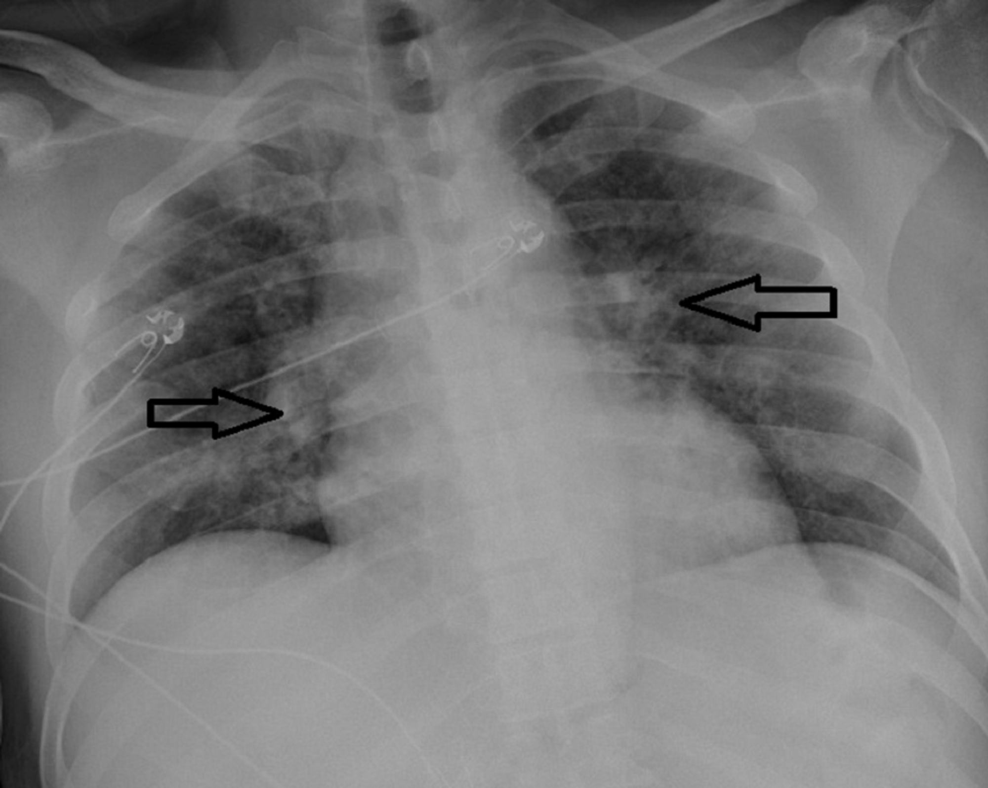 Cureus Diabetic Ketoacidosis in Coronavirus Disease Patients With Type 2 Diabetes Mellitus