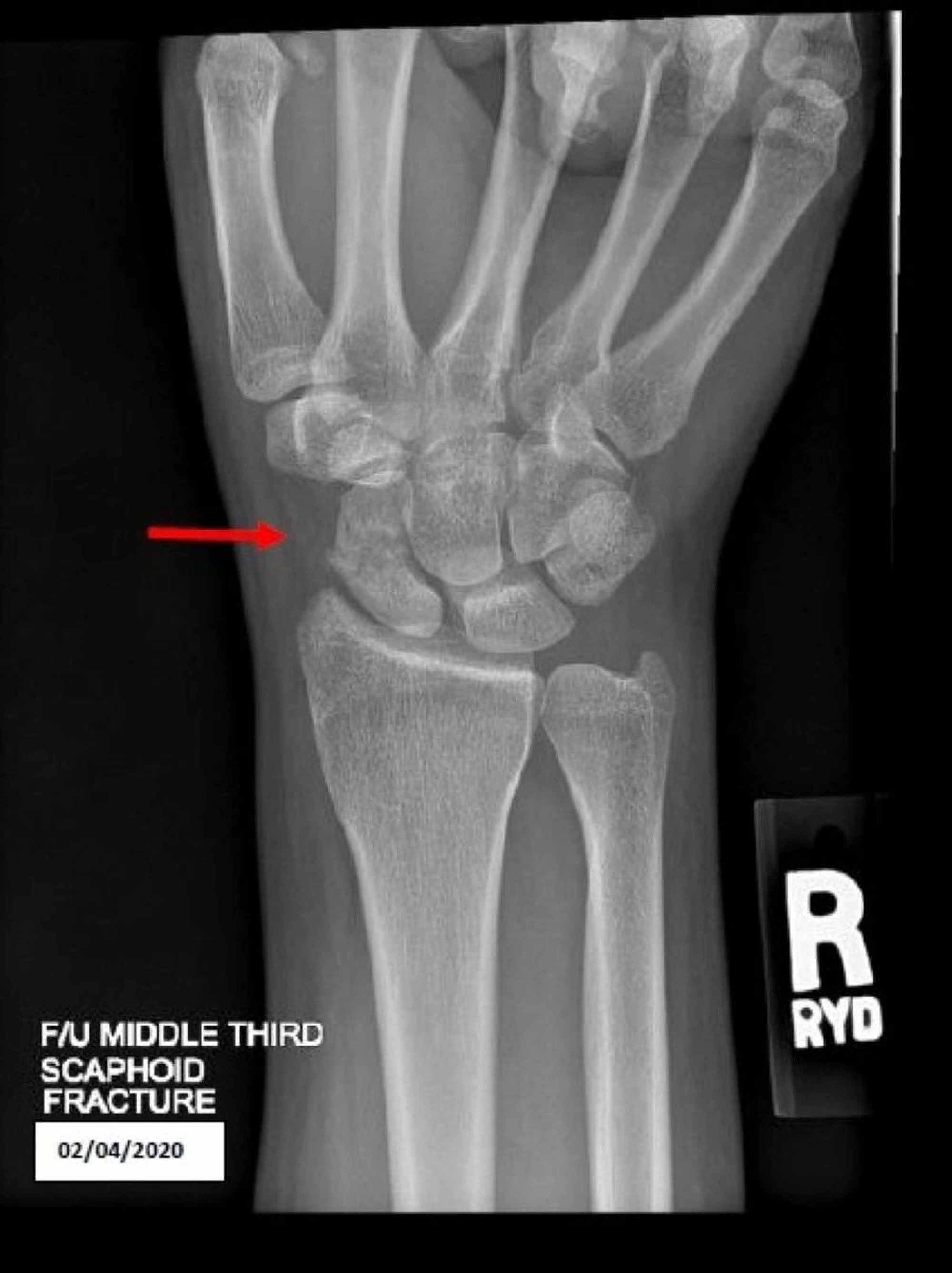 scaphoid-bone-fracture-christmasjoker