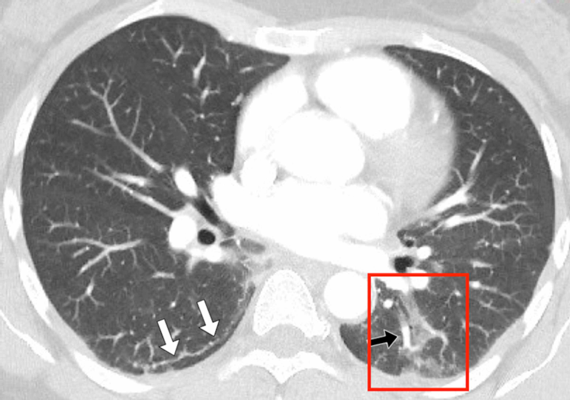 Cureus Positive Chest Ct Features In Patients With Covid 19 Pneumonia And Negative Real Time Polymerase Chain Reaction Test