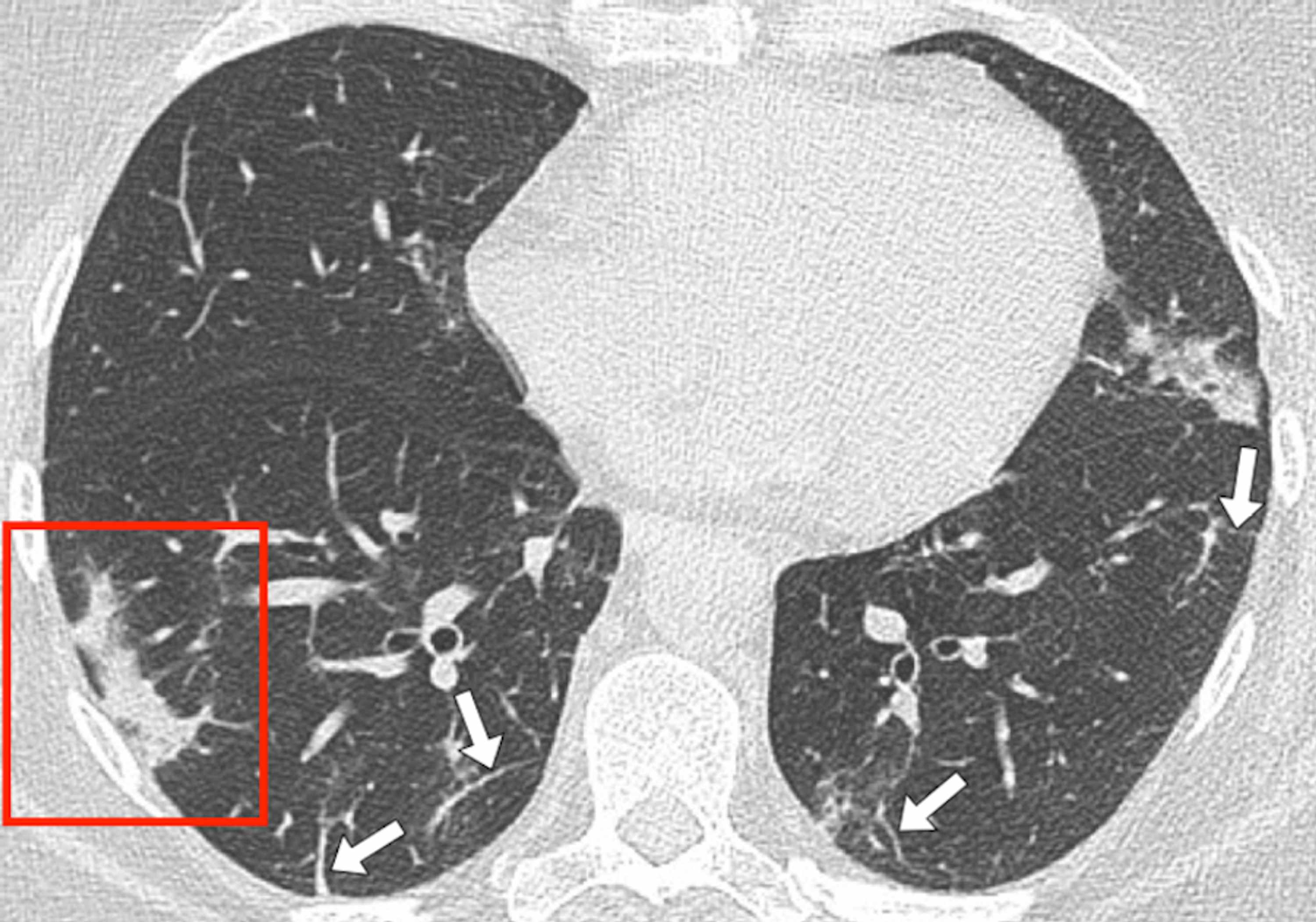 Cureus Positive Chest Ct Features In Patients With Covid 19 Pneumonia And Negative Real Time Polymerase Chain Reaction Test