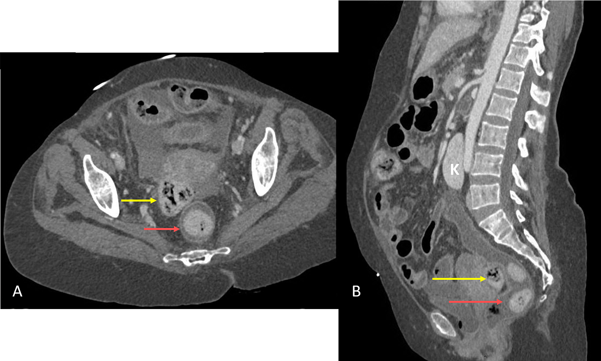 Cureus Stercoral Perforation Of Sigmoid Colon In Systemic Lupus Erythematosus A Rare Cause Of 1271