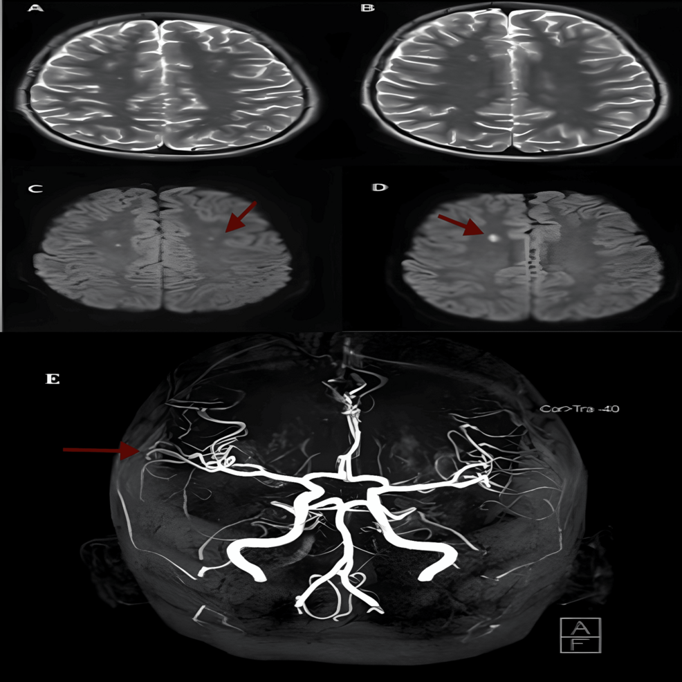 Neuropsychiatric Systemic Lupus Erythematosus in a Pediatric Male Patient