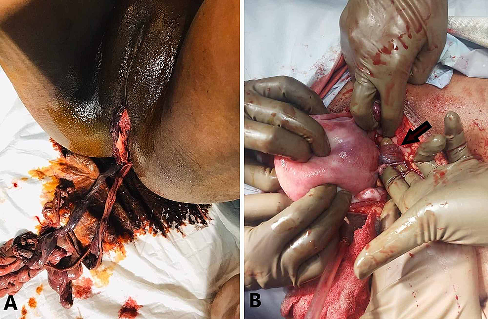 Cureus  Rupture of Unscarred Uterus With Intestinal Prolapse From