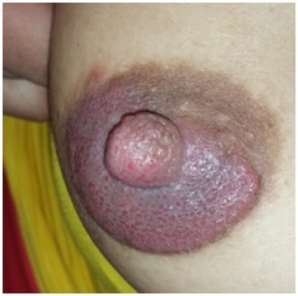 Patient’s-breast-manifestations-(areola-hyperkeratosis-and-discharge)