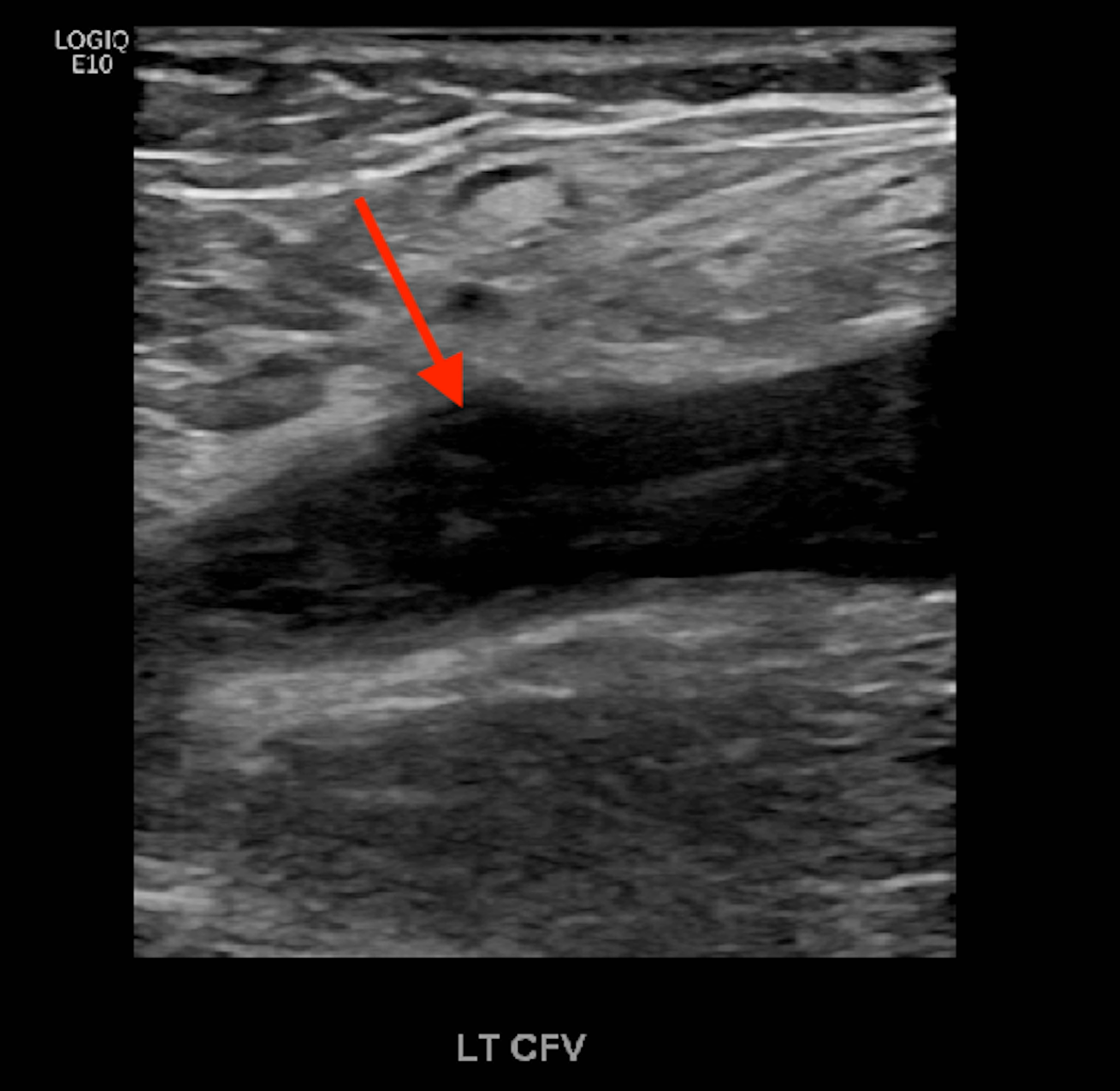 Cureus | A Case of Phlegmasia Cerulea Dolens