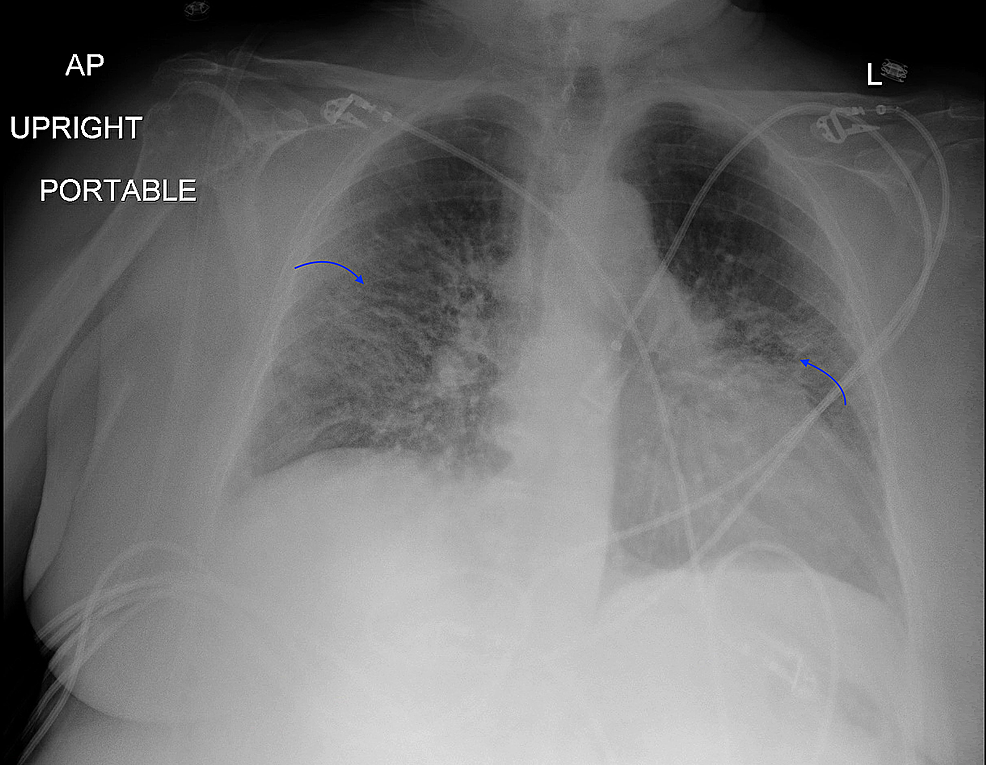 cureus-s-ndrome-de-hamman-rich-a-diagnosis-of-exclusion-in-the-covid