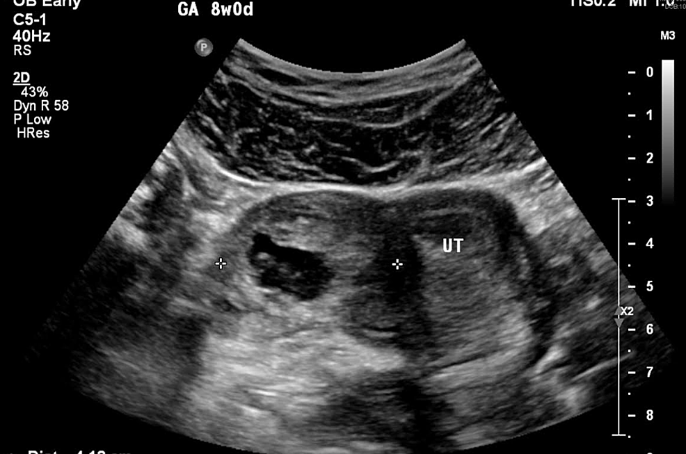 Ectopic Pregnancy Ultrasound 4 Weeks