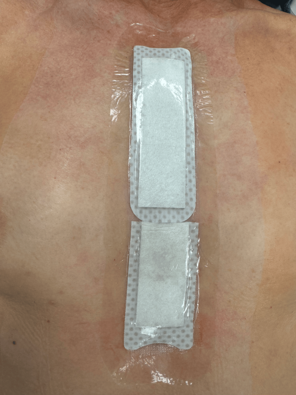 Novel Use of an Electroceutical Wound Dressing to Complement Wound Closure in High-Risk Sternotomy Patients: Clinical Safety and Outcomes | Cureus Novel Use of an Electroceutical Wound Dressing to Complement Wound Closure in High-Risk Sternotomy Patients: Clinical Safety and Outcomes | Cureus