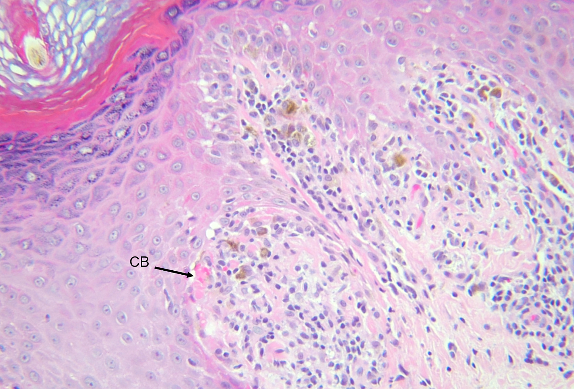 Cureus | Eruptive Lichen Planus Associated With Chronic Hepatitis C ...