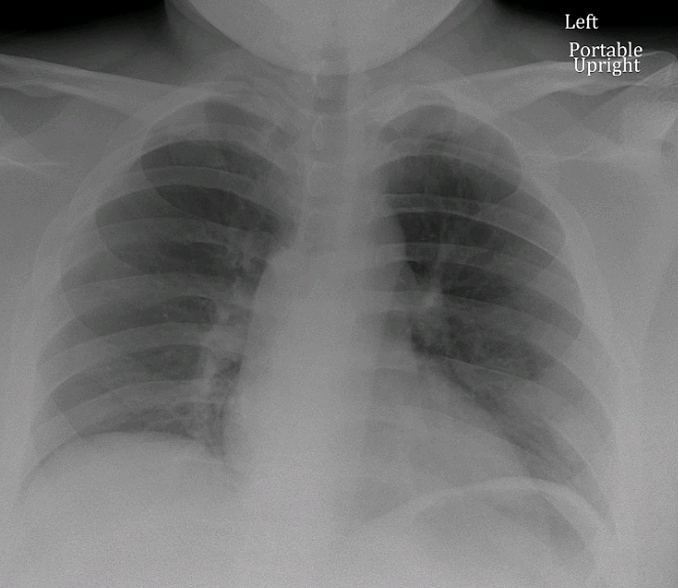 Admission-chest-x-ray