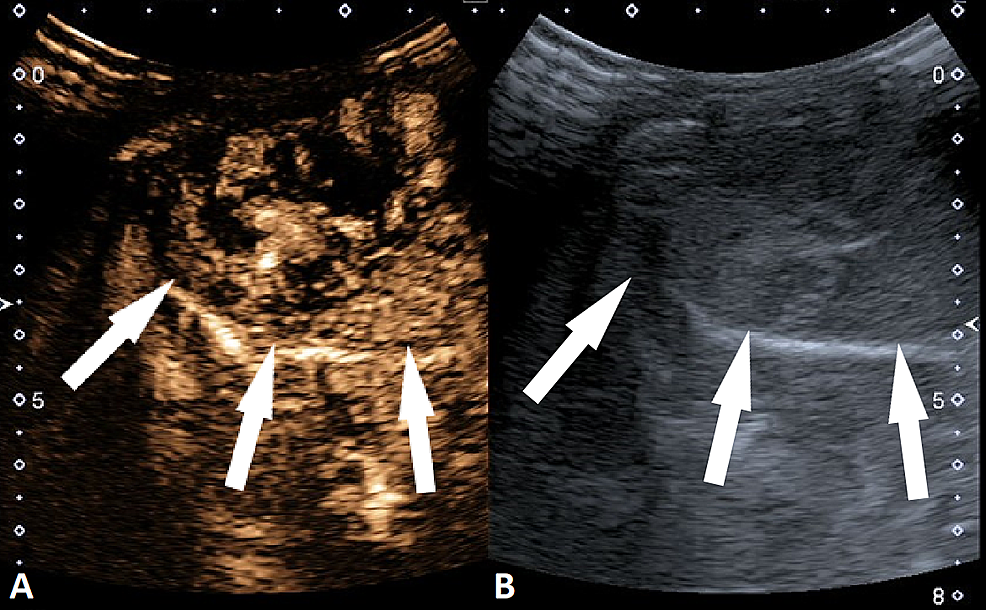 Cureus | Contrast-Enhanced Ultrasound For The Characterization Of ...