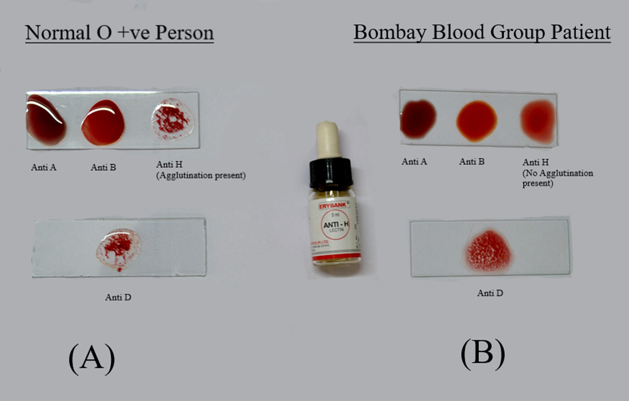 Cureus | Secondary Postpartum Hemorrhage Presenting With Bombay Blood ...