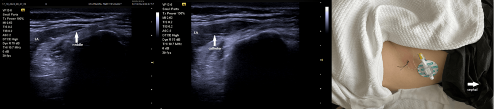 Suprainguinal-fascia-iliaca-block-catheter