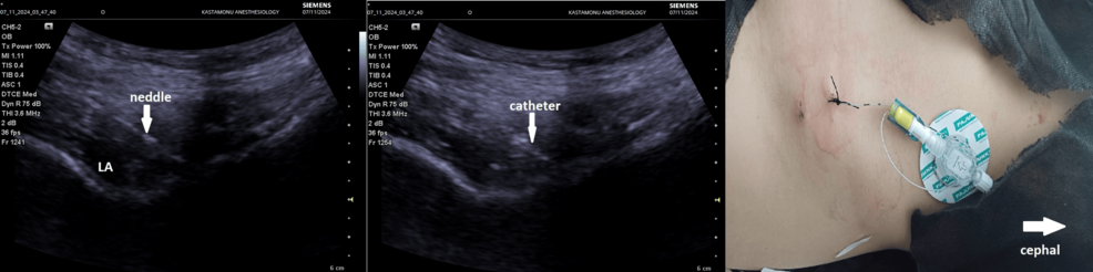 Pericapsular-nerve-group-block-catheter