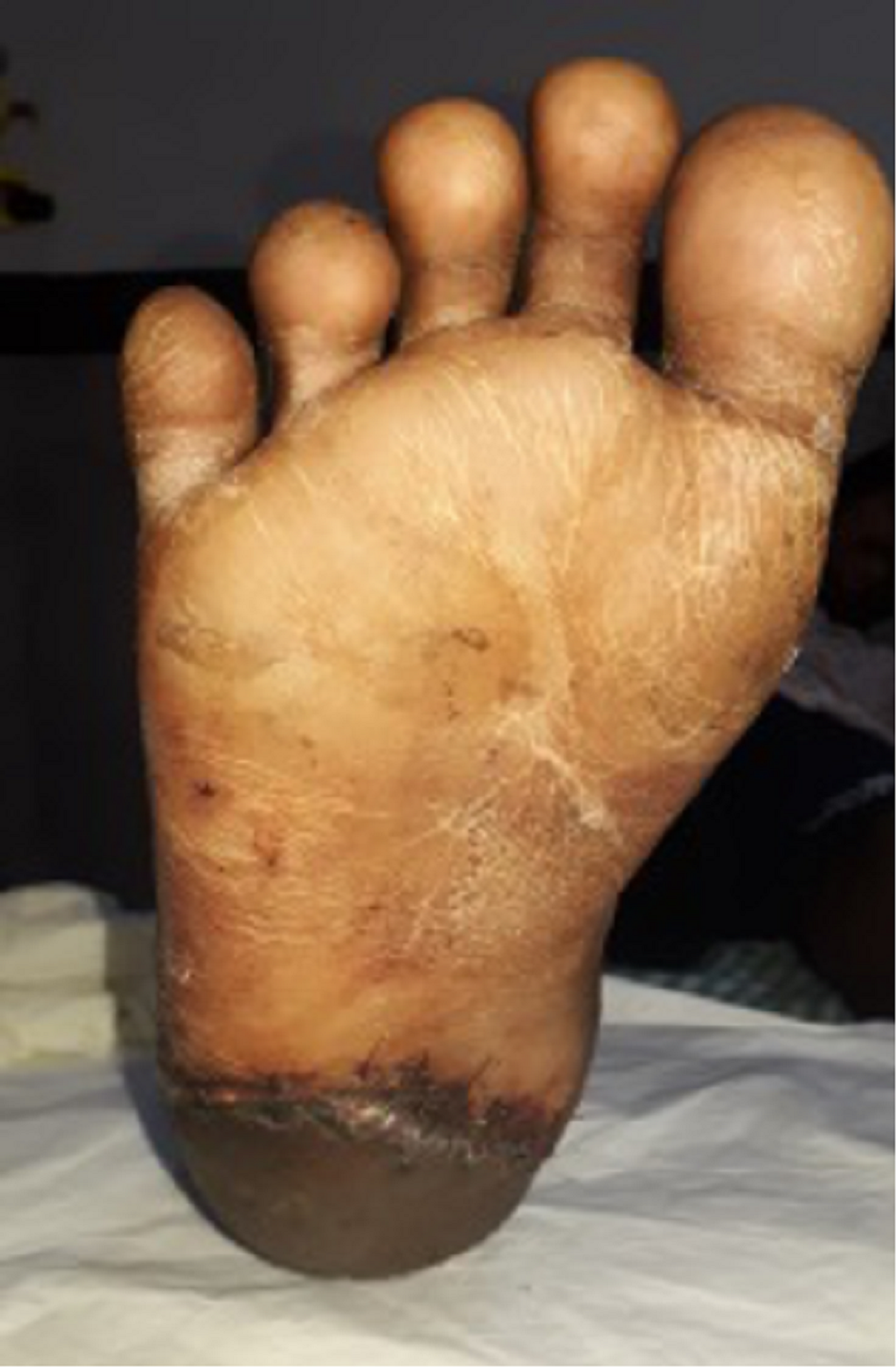 Cureus Negative Pressure Wound Therapy With Flap Reconstruction for